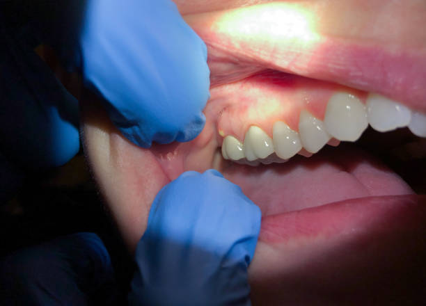 Best Emergency Dentist for Lost Fillings or Crowns in Middletown, CA