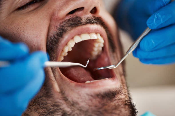 Best Emergency Dental Extractions in Middletown, CA